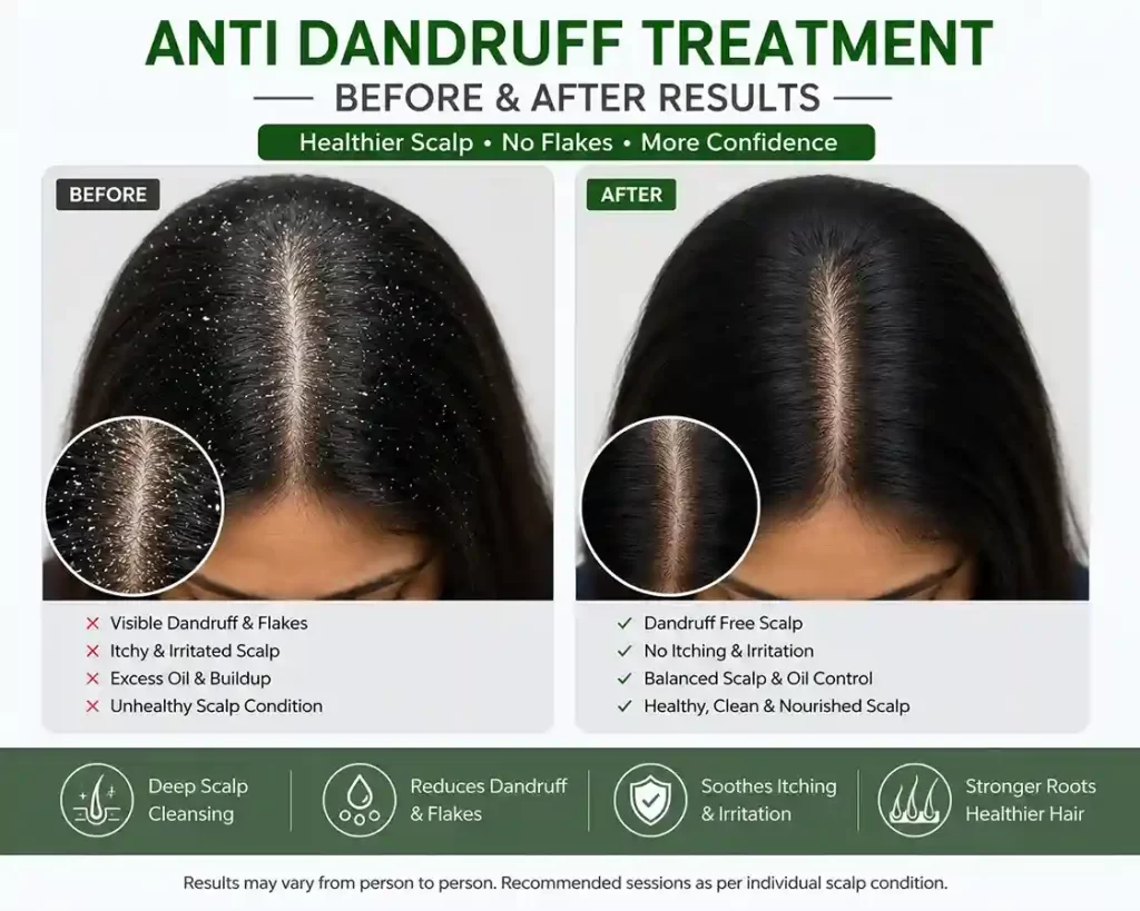 antidandruff treatment in salem