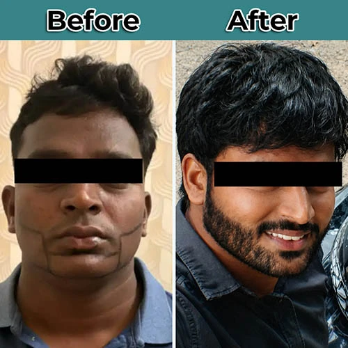 beard transplant