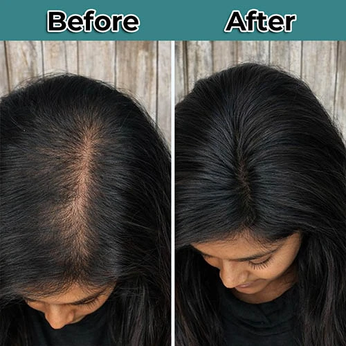 female hair transplant