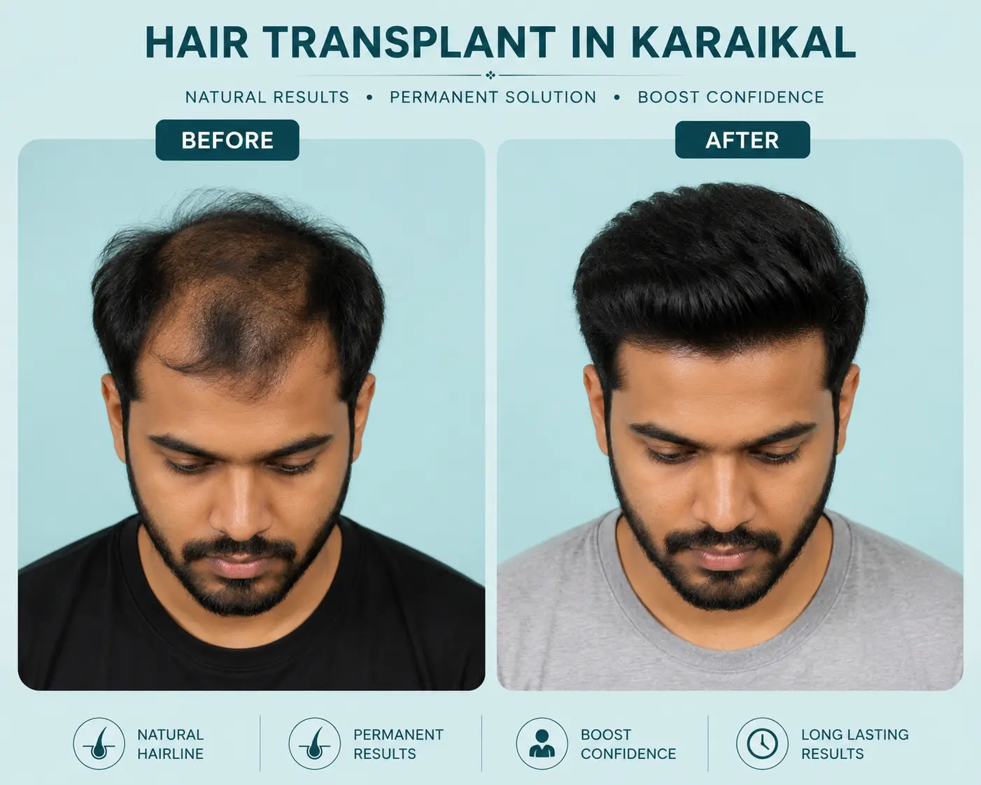 hair transplant in karaikal