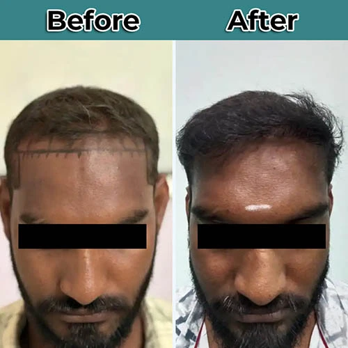 mesotheraphy 