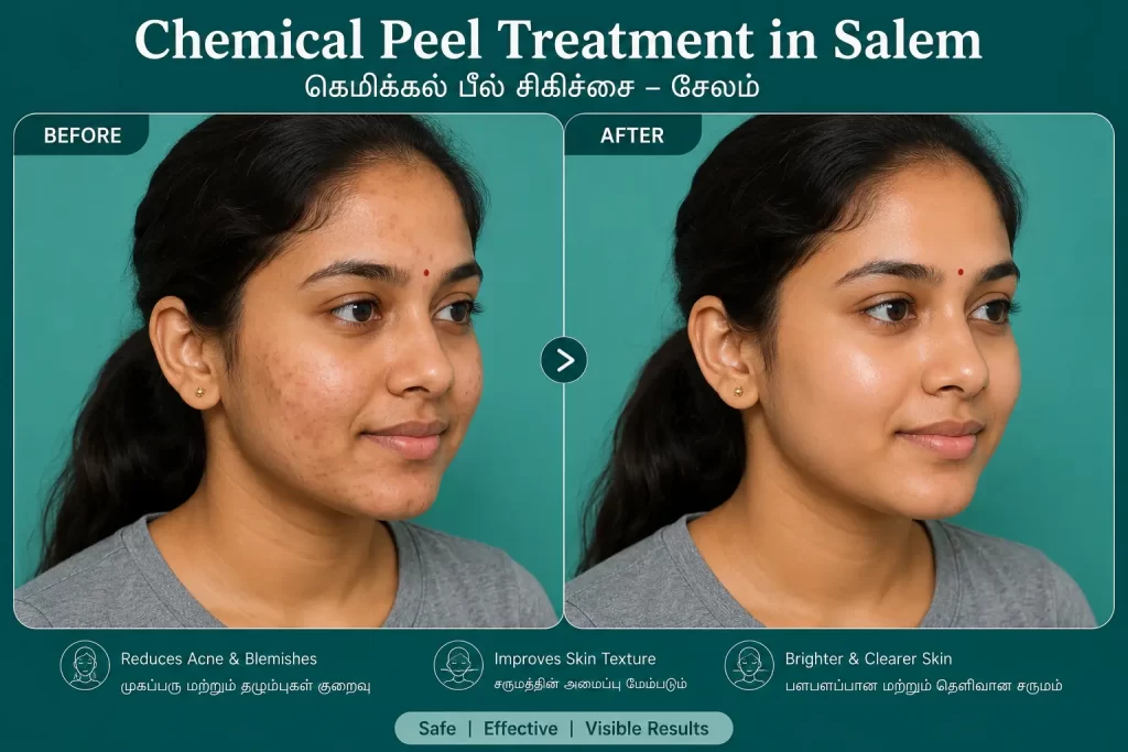 chemical peel treatment in salem