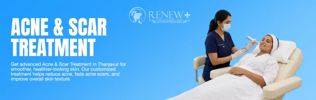 acne and scar treatment in thanjavur post