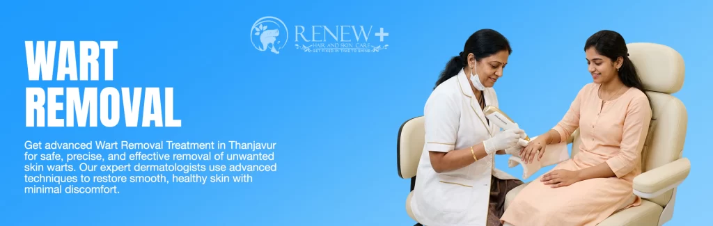 wart removal in thanjavur post