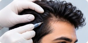 Fue Hair Treatment